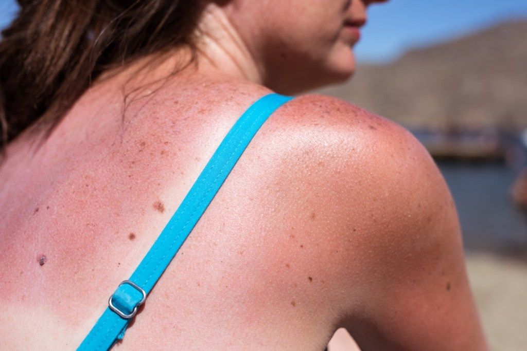 žena s opeklinama na plaži što se događa s vašim tijelom kad dobijete opekline