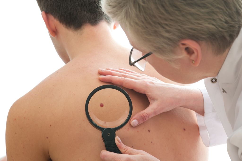 سرطان الجلد ، أسئلة صحية بعد 40