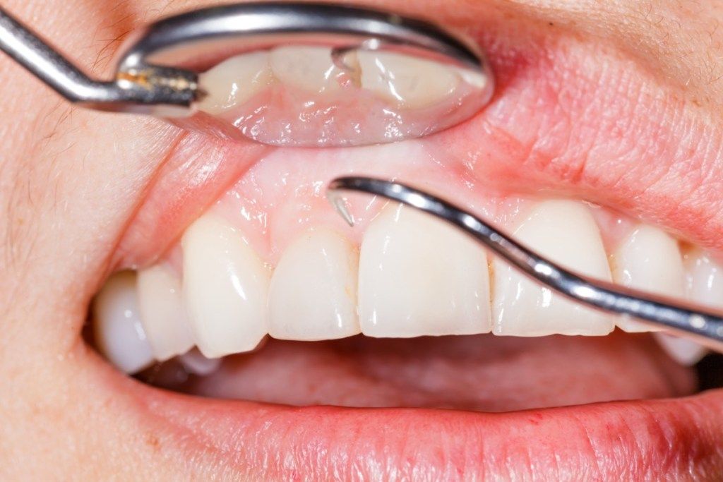valkoinen henkilö hammaslääkärillä saa hampaat puhtaiksi