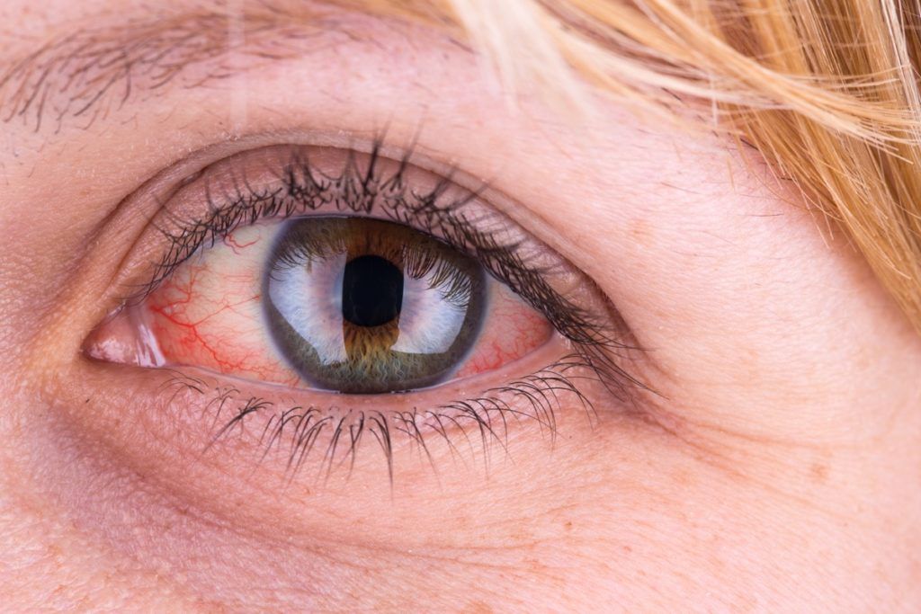 mujer blanca de mediana edad con ojos rojos