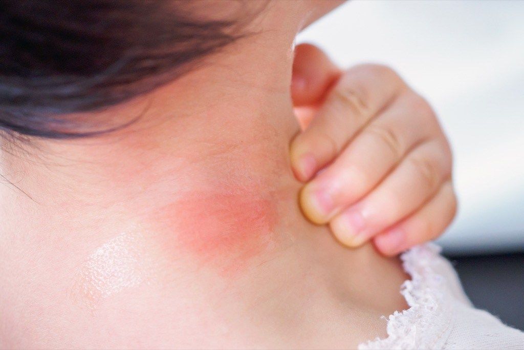 Punainen turvonnut virhepurenta allerginen reaktio