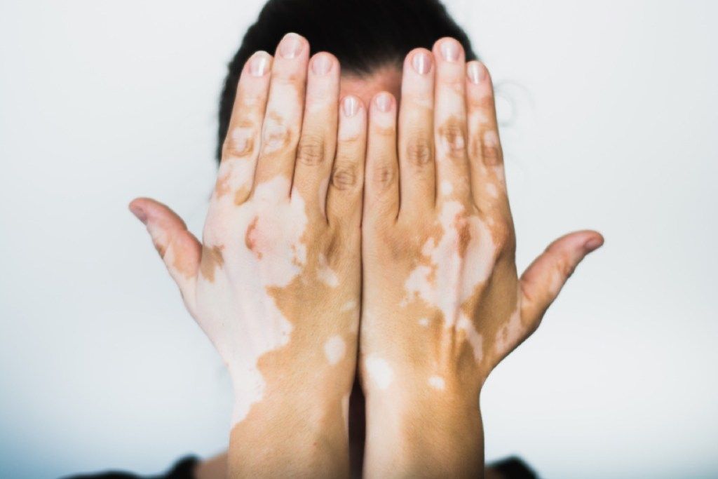 vrouw met vitiligo, feiten over huidkanker