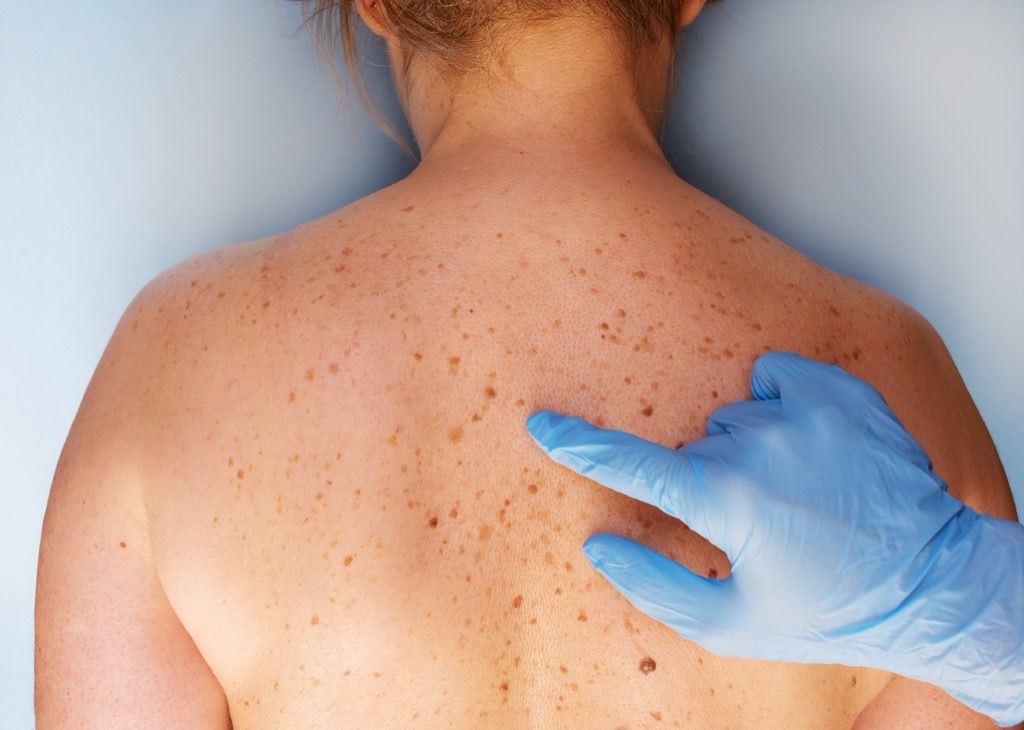 novi madeži, dejstva o kožnem raku