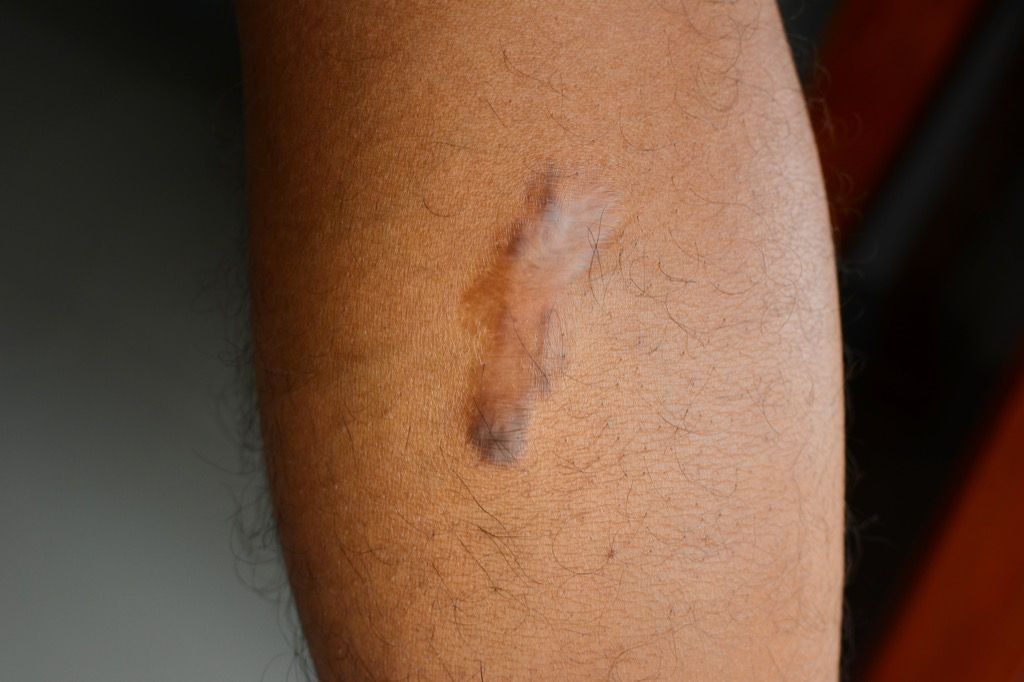 smeđi ožiljak, činjenice o raku kože