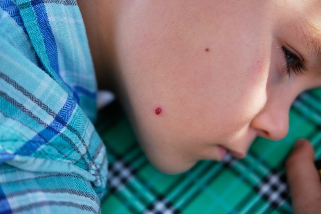 سرخ تل جلد کے کینسر کی علامات کے ساتھ بچہ