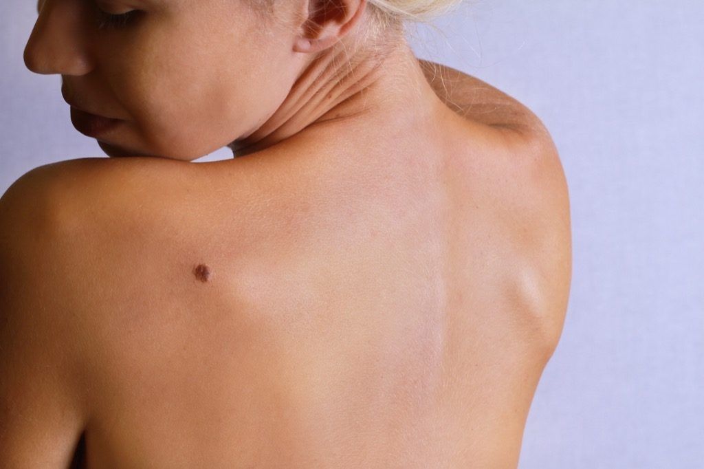 moles جسمانی خامیاں جلد کے کینسر کی علامات