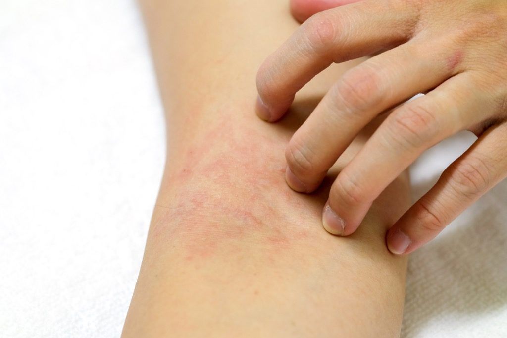 20 de simptome ale cancerului de piele pe care toată lumea trebuie să le cunoască