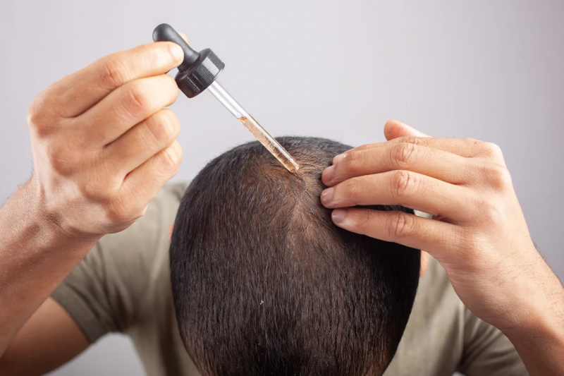   Vīrietis lieto minoksidilu galvas ādā, lai ārstētu matu izkrišanu.