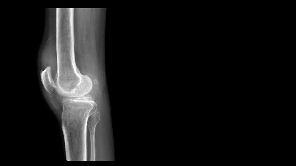 X-ray lutut dengan fabella