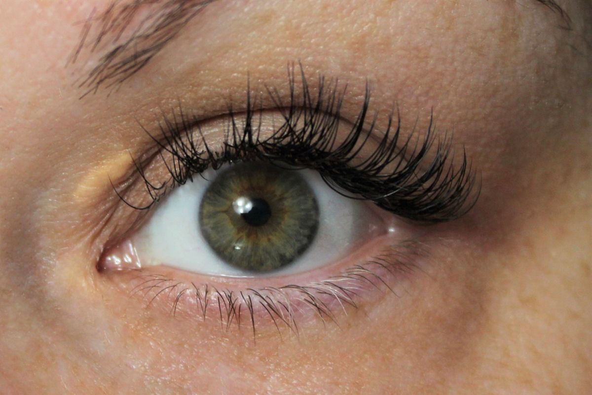 ภาพโคลสอัพบนใบหน้าของผู้หญิงที่มีคอเลสเตอรอลสูงจะมี xanthelasma ที่ตา