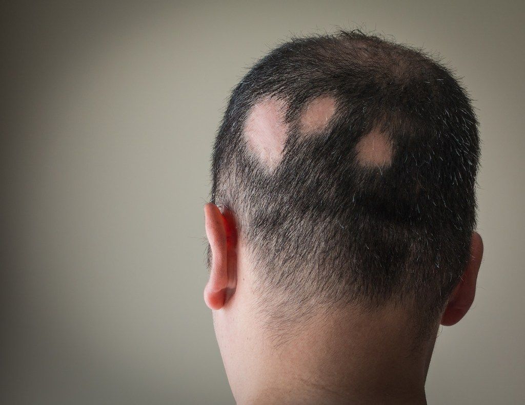 Hombre con alopecia