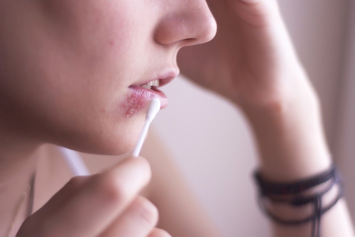Wajah wanita dengan herpes di bibir