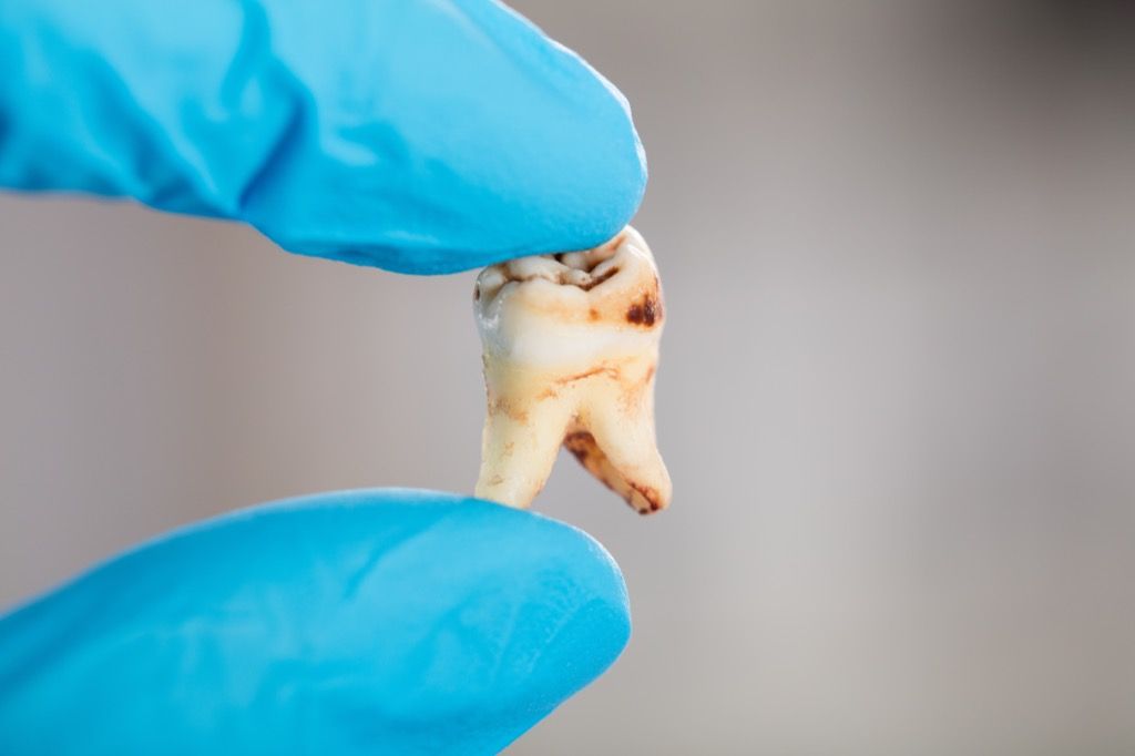 kerosakan gigi pada gigi yang dikeluarkan, cara badan anda berubah selepas 40