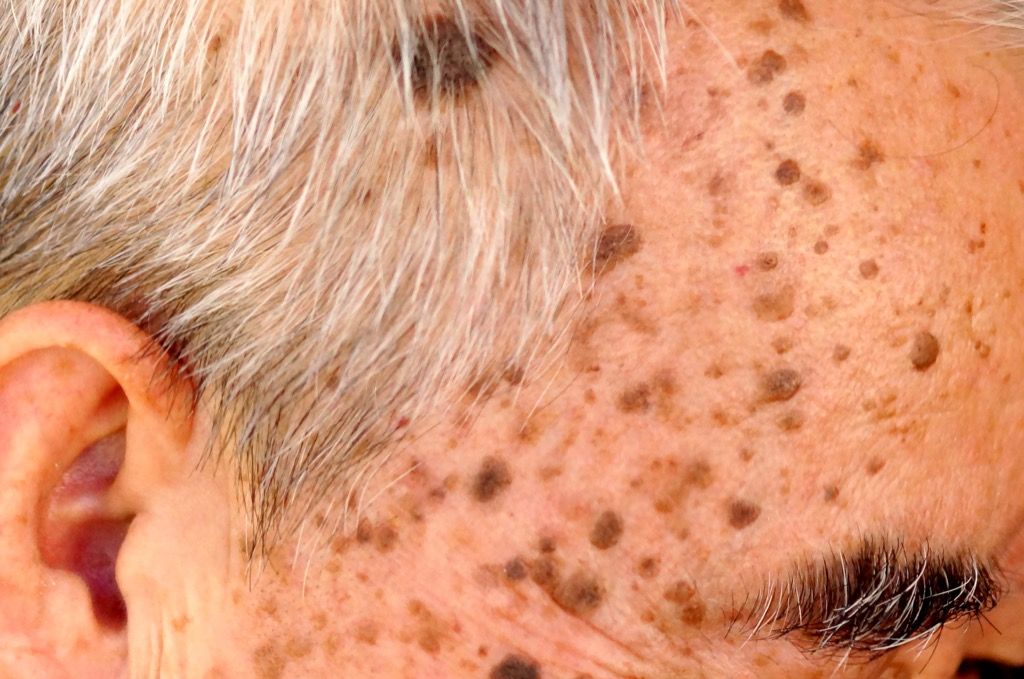 raue Haut und Altersflecken, wie sich Ihr Körper nach 40 verändert