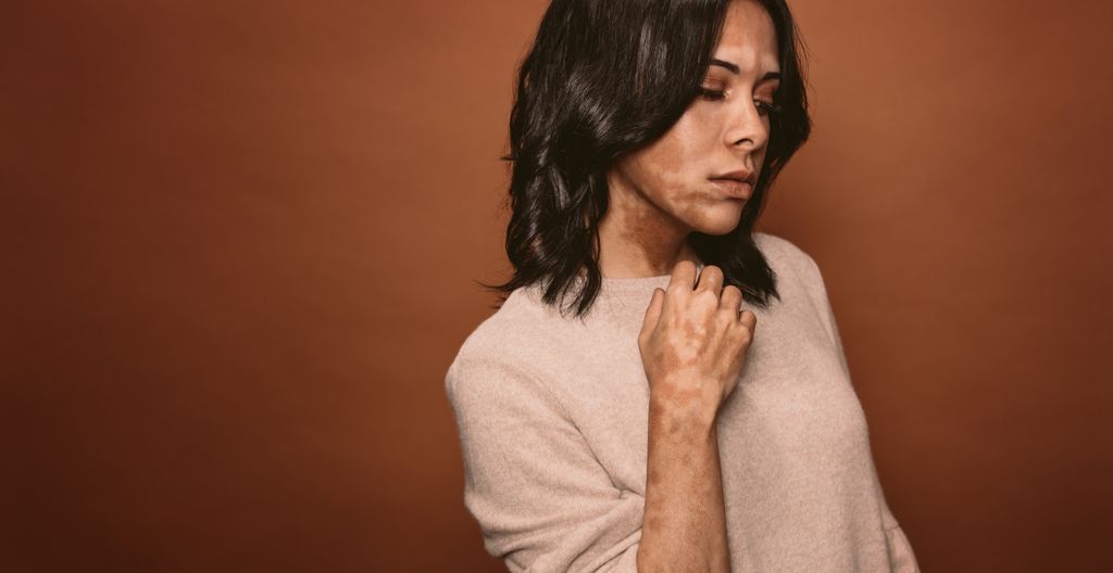 Vitiligo-nainen allekirjoittaa hiuksesi harmaaksi