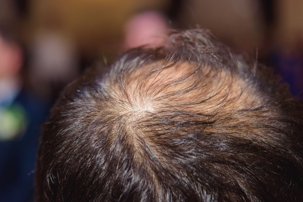 Alopecijos plaukų slinkimas rodo, kad plaukai papilkės