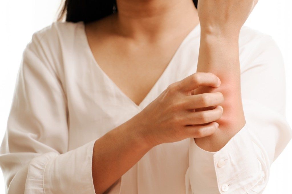Mujer rascándose un sarpullido en el brazo {Síntomas de alergia}