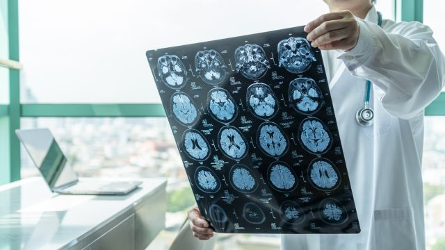 Šis Alzheimerio vaistas sumažina simptomus 30 procentų, sakoma naujame tyrime