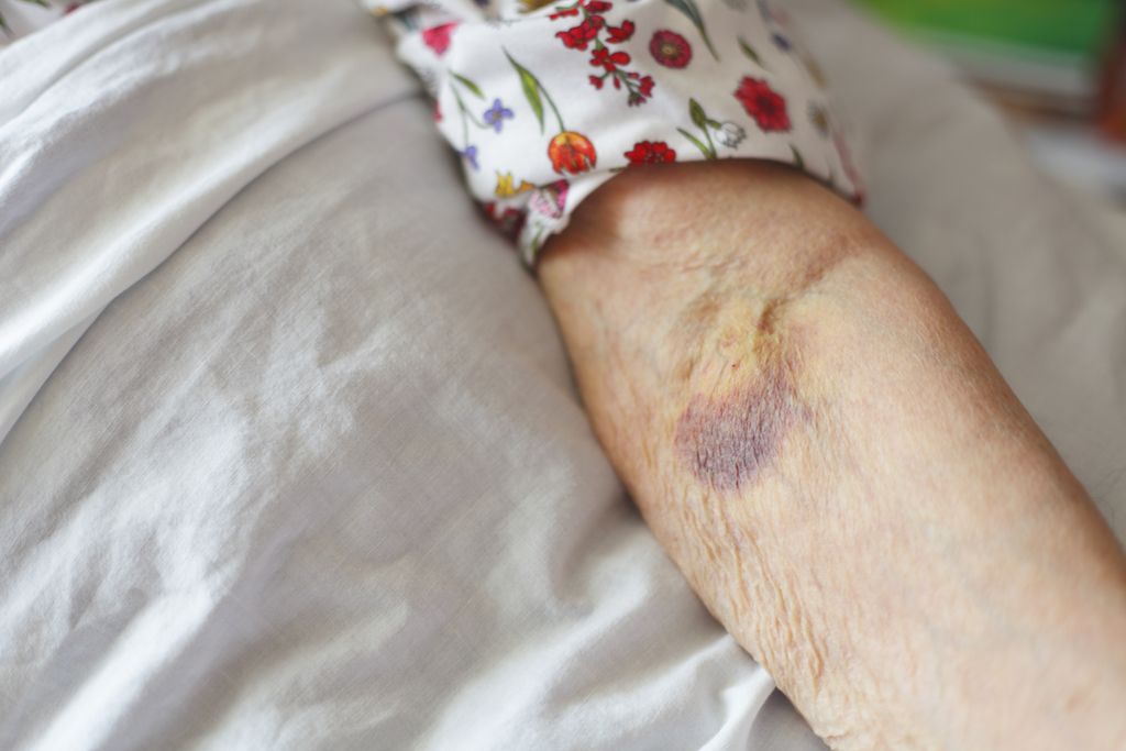 gammel kvinde med et blå mærke på armen