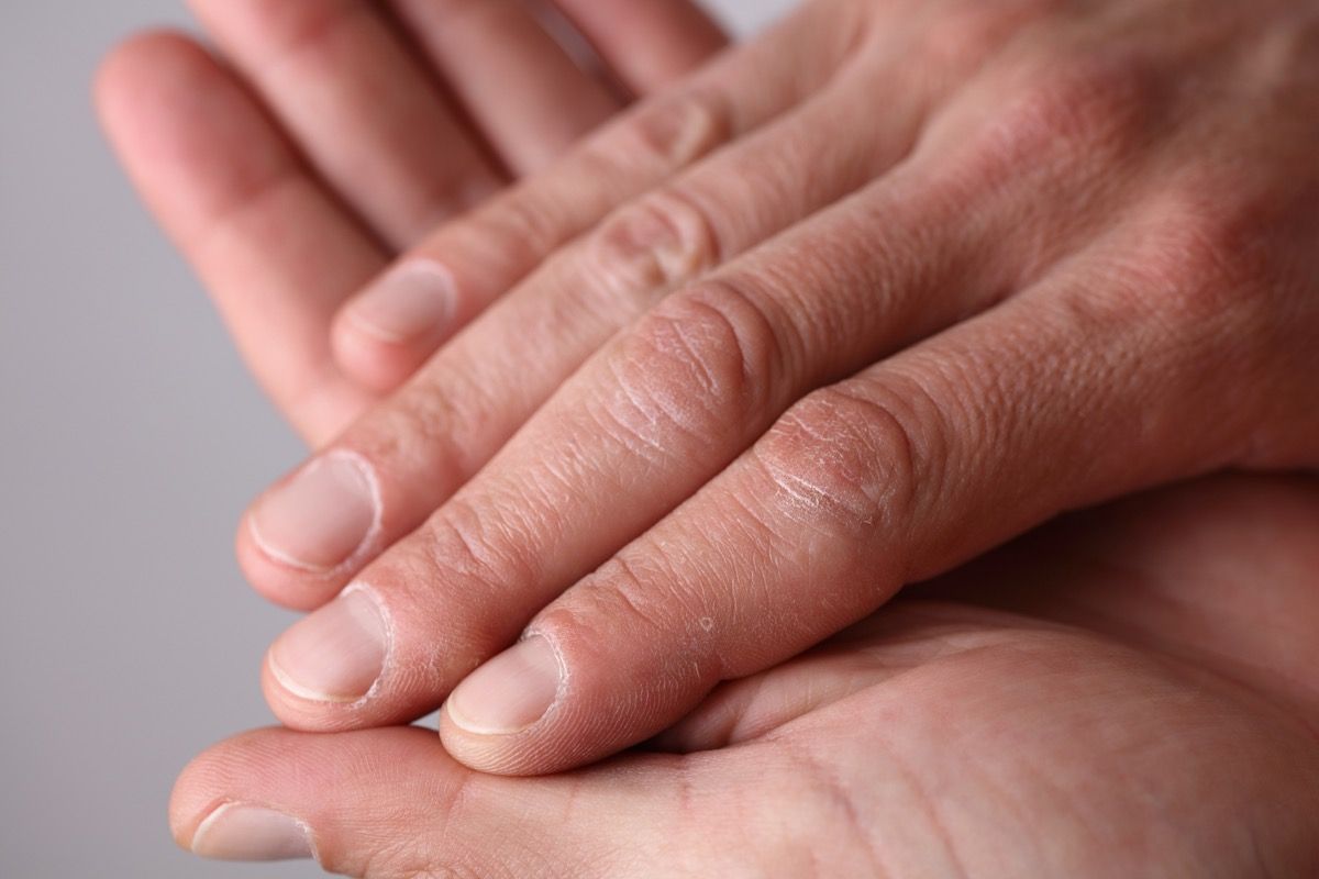 Męskie dłonie z bliska, sucha skóra, koncepcja pielęgnacji skóry zimą