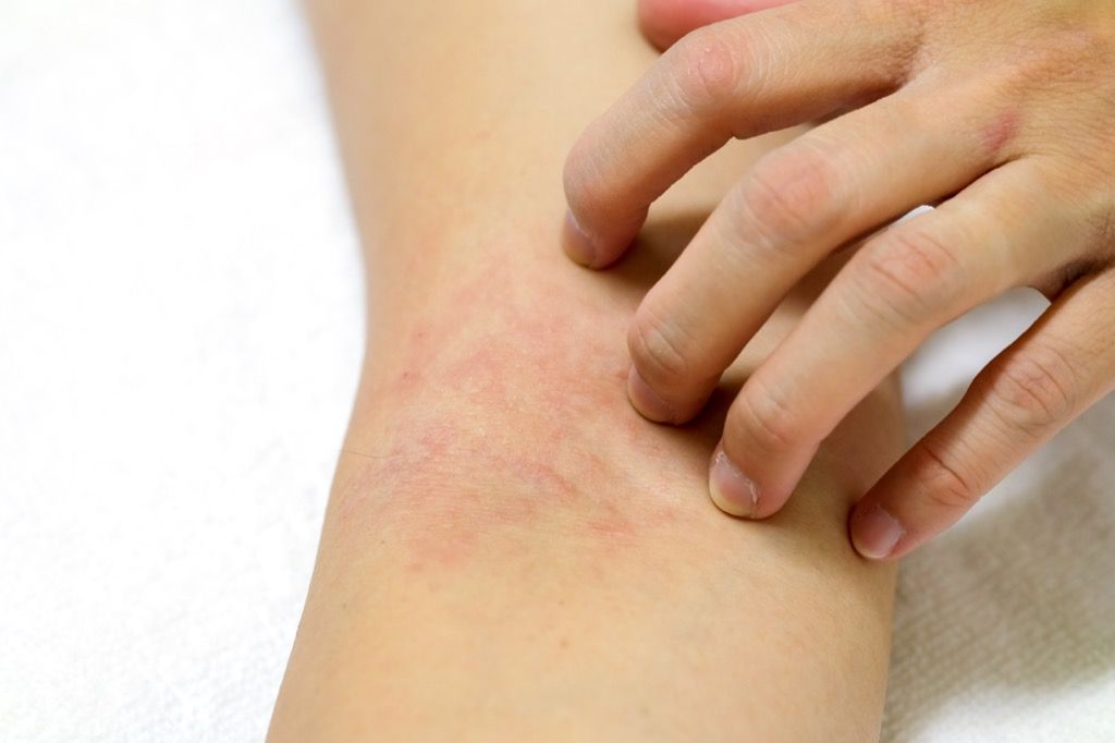 kvinde skraber udslæt på armen, tegn på din forkølelse er alvorlig