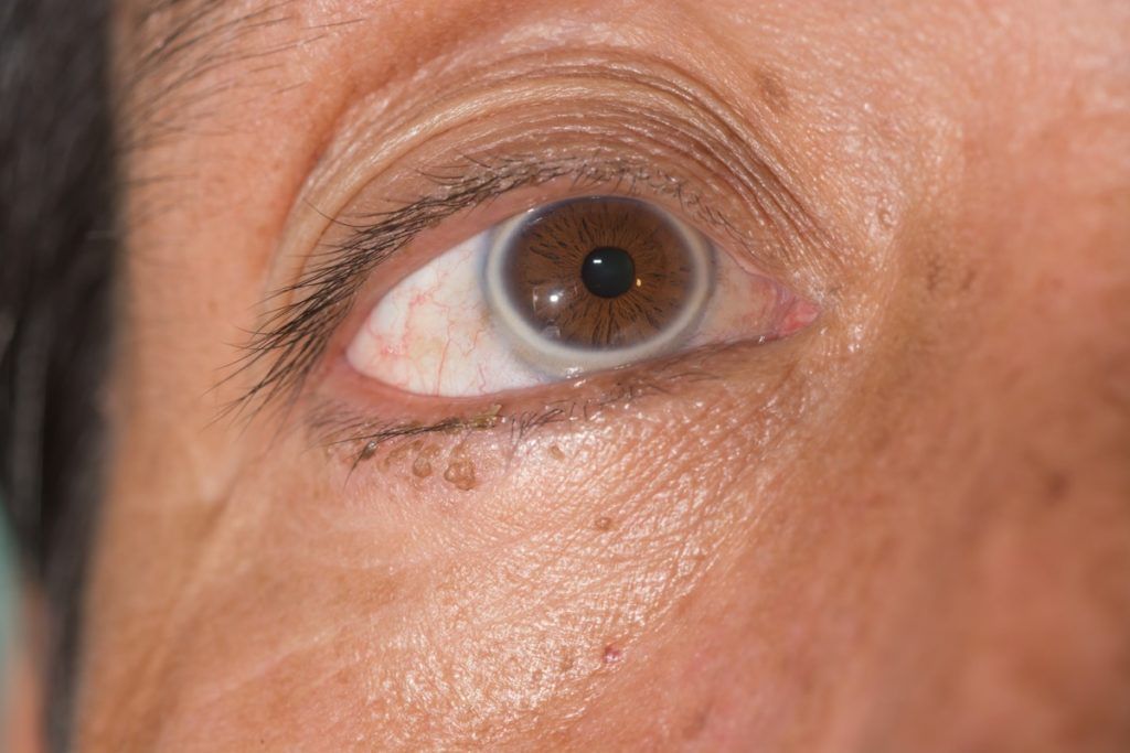 uždaryti arcus senilis atliekant oftalmologinį tyrimą. - Vaizdas