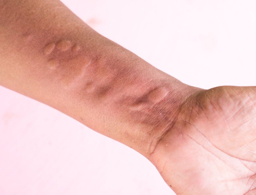 7 ženklai, jūsų oda bando pasakyti, kad turite koronavirusą