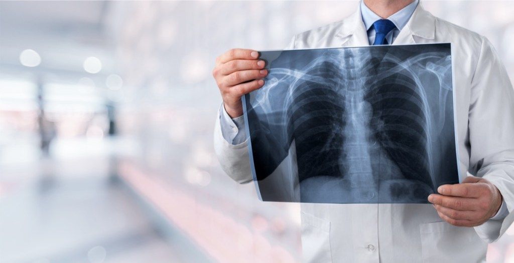 zdravnik, ki drži rentgenski pljuč