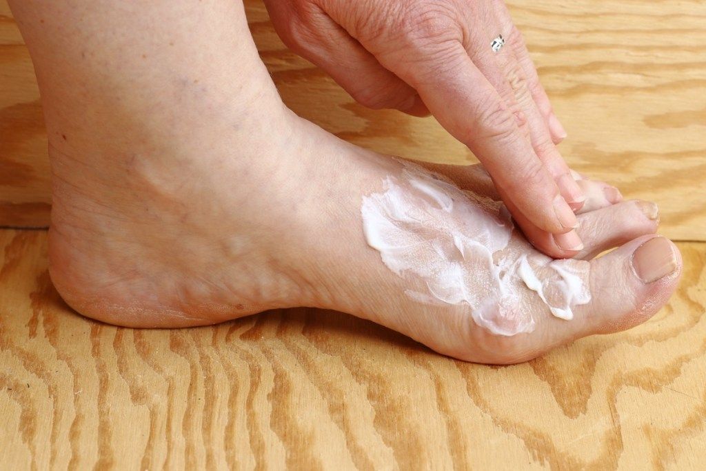 Жена, използваща крем за крака за гъбична инфекция Симптоми на безшумно здраве