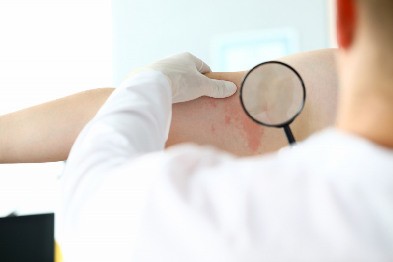   Дерматолог изследва червен обрив на пациент's skin