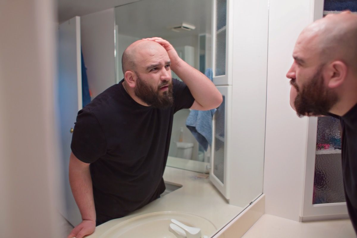 seorang pria yang tidak bahagia melihat ke cermin sambil menyentuh rambut yang hilang di atas kepalanya