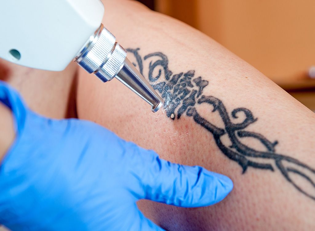Tatovering, fjernelse af tatoveringer, 40