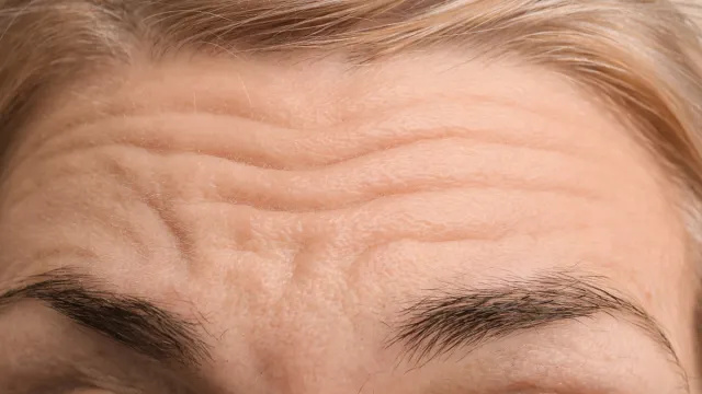 So werden Sie Stirnfalten los: 18 von Dermatologen anerkannte Tipps