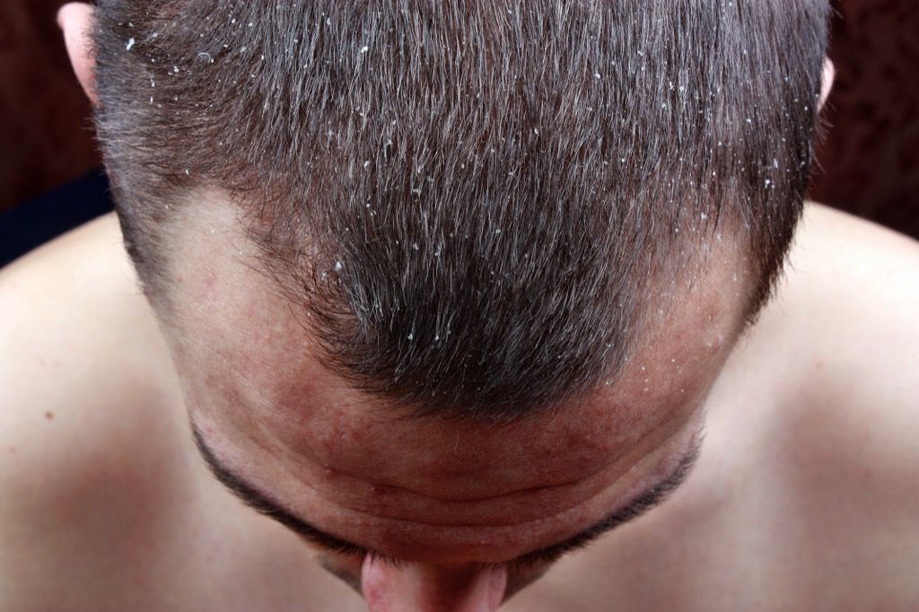 sausi galvos odos pleiskanos plaukai